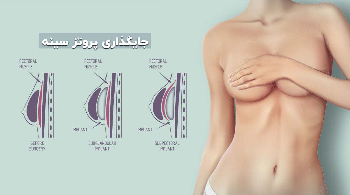 پروتز سينه اقساطي در تهران