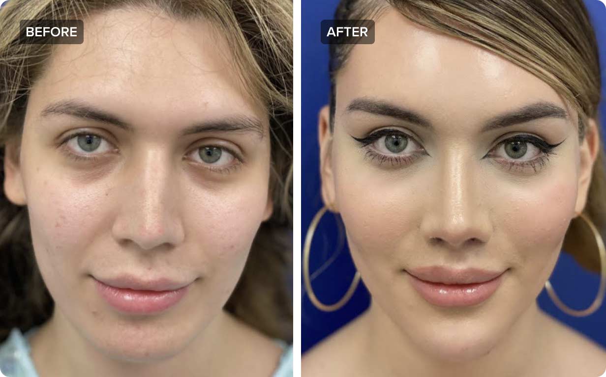 جراحی زنانه کردن صورت قبل و بعد
